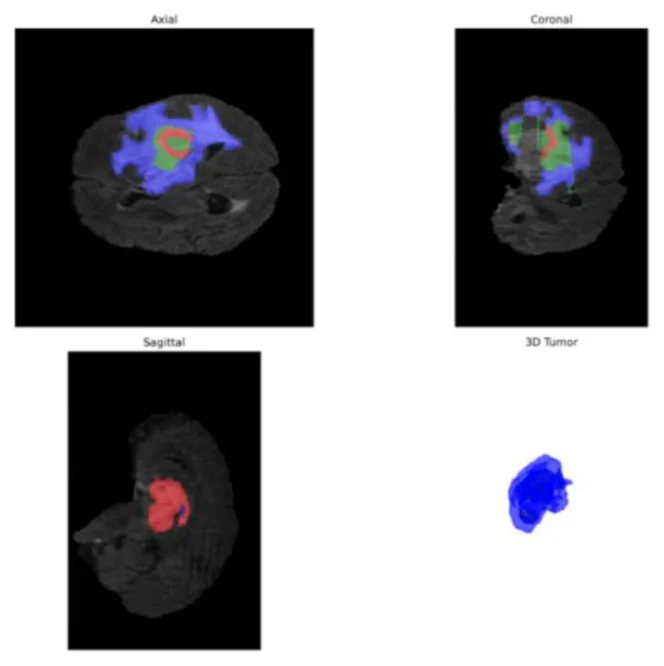 Fig. 2 from "NeuroAssist: ML-Driven MRI Vision for Brain Tumor Analysis": Segmentation in axial, coronal and sagittal planes, with a 3D reconstruction of the tumour.